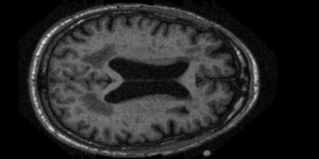 MRI brain scan