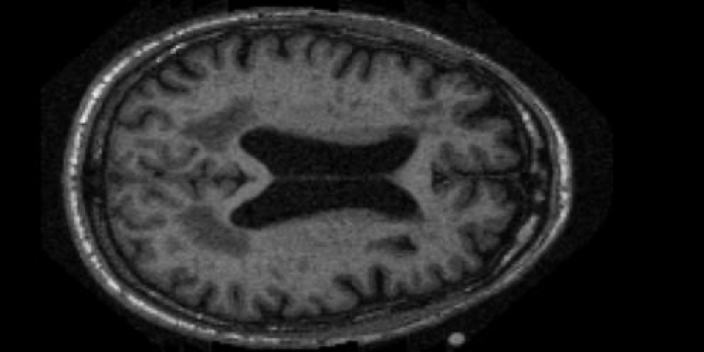 MRI brain scan